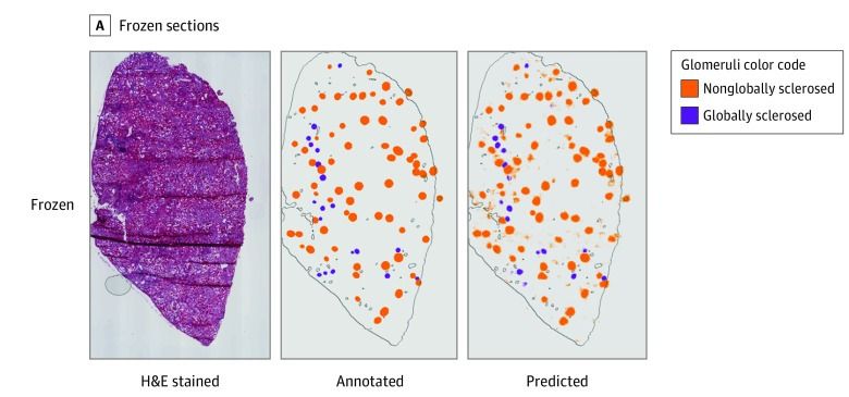 A frozen-section kidney biopsy shown three ways: H&E stained, annotated by a pathologist, and as predicted by the deep learning model, with sclerosed and non-sclerosed glomeruli in different colors.