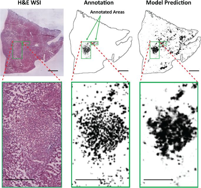 A donor liver biopsy shown as an H&E slide, a pathologist annotation and a model prediction of steatosis, with magnified insets.